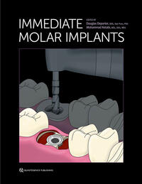 Immediate Molar Implants