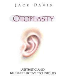 Otoplasty