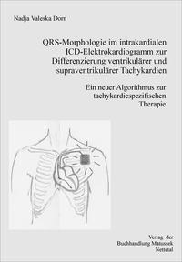 QRS-Morphologie im intrakardialen ICD-Elektrokardiogramm zur Differenzierung supraventrikulärer von ventrikulären Tachykardien