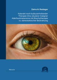 Katarakt nach bulbuserhaltender Therapie intra-okulärer maligner Aderhautmelanome mit Brachytherapie vs. stereotaktischer Bestrahlung